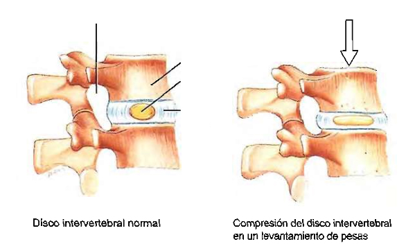 agujero intervertebral