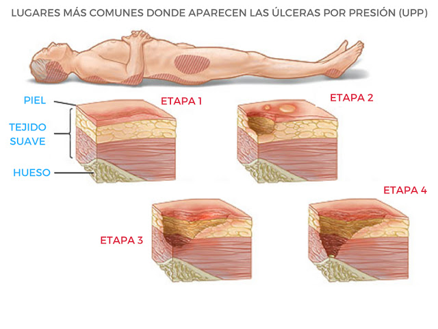 Print Map Quiz: Grados de ulceras por presión (ulceras por presión ...