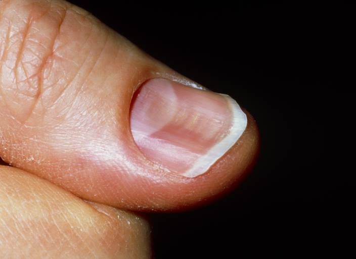 Alphabetical Repertory of Nail disorders based on Hering's guiding symptoms  of our materia medica