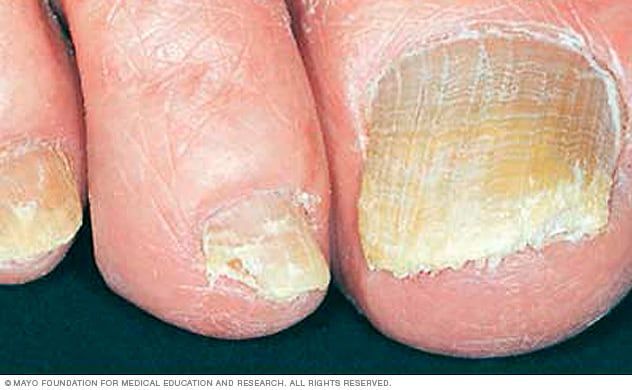 Types of nail diseases :Trachyonychia Trachyonychia - a kind of  onychodistrophy, in which the nail plate becomes.. | VK