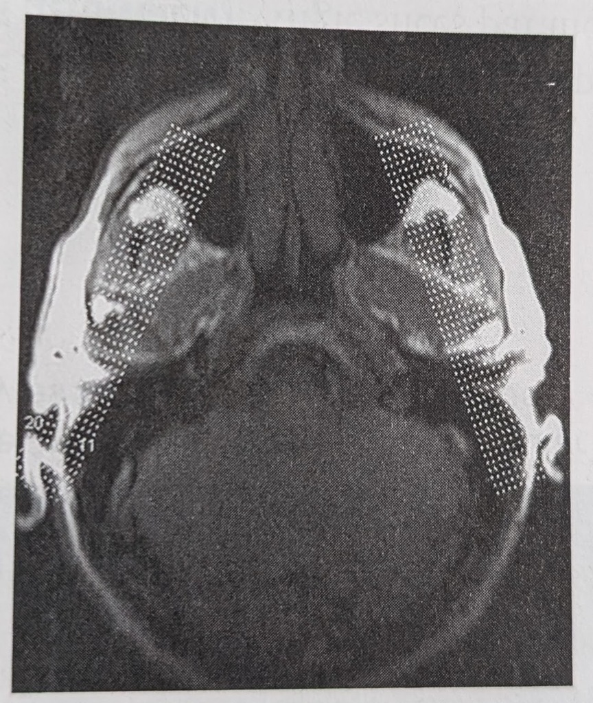 Matching Pairs: MRI Pituitary, IAC's, Orbits, MS, Temporal Lobe, and ...
