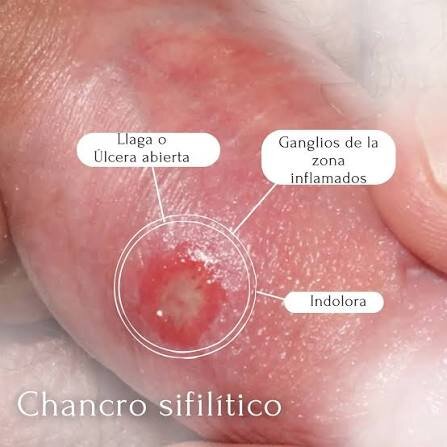 NO doloroso