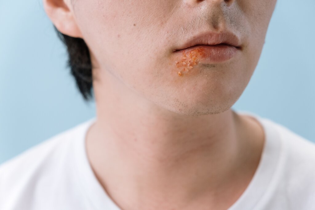 Herpes.