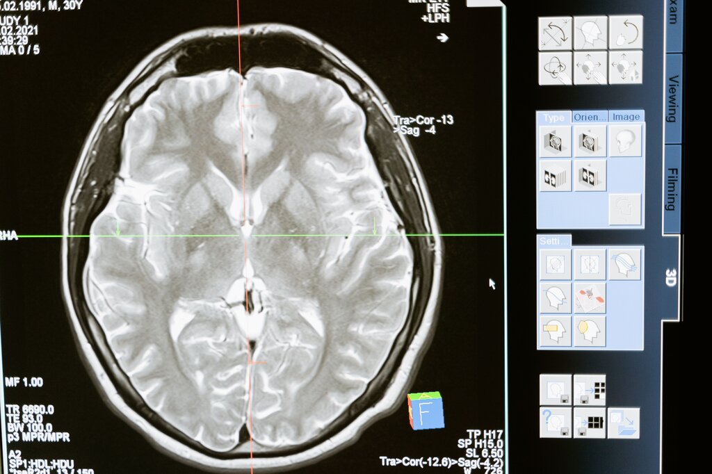 De la epilepsia 