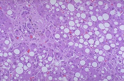 ¿Qué patrón morfológico de lesión celular reversible se observa en la siguiente cortesía histológica, caracterizado por la presencia de múltiples vacuolas lipídicas ópticamente vacías en el citoplasma de los hepatocitos?