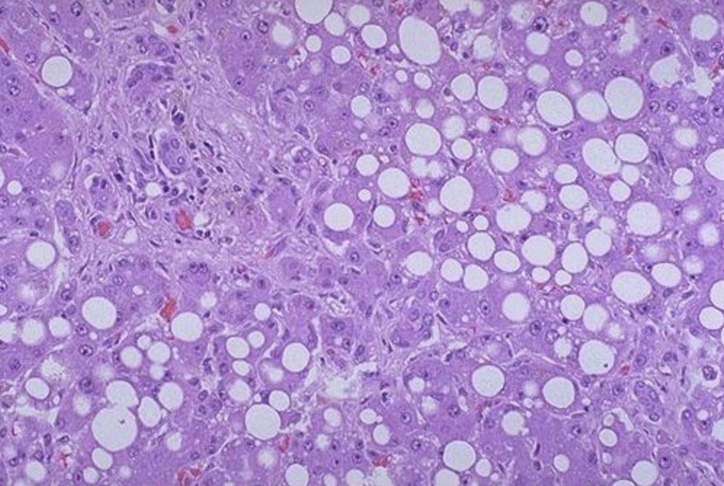 Observe la lámina histológica de hígado con múltiples vacuolas claras en el citoplasma de los hepatocitos presentada en el material. ¿Qué alteración celular representa? 