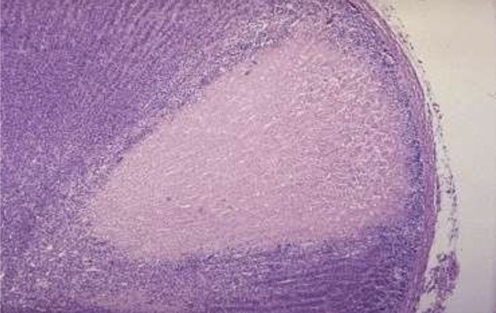 Observe la lámina de necrosis coagulativa/isquémica presentada en el material. ¿Cuál es el hallazgo microscópico característico de este tipo de necrosis? 