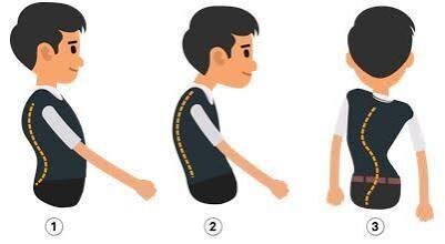 jika seseorang mengalami kelainan tulang seperti gambar no 2 , nama kelainan tersebut adalah