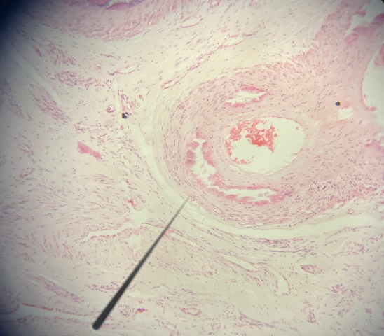 9. En la calcificación de la media arterial (arteriosclerosis de Monckeberg) observada en el útero, ¿qué túnicas se mantienen típicamente respetadas?