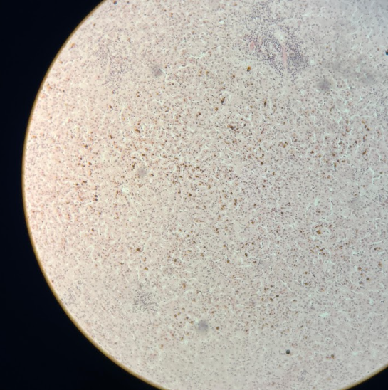 5. Al observar un corte histopatológico de hígado con colestasis, ¿qué hallazgo microscópico confirma la presencia de este proceso?
