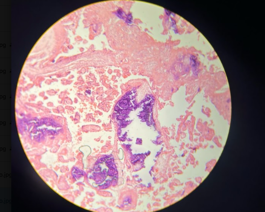 7. En un corte de placenta con infarto placentario, ¿qué tipo de calcificación se presenta y cuál es su característica microscópica al corte con H&E?